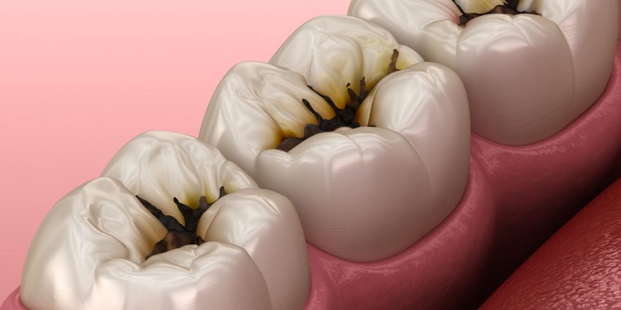 Molar,Teeth,Damaged,By,Caries.,Medically,Accurate,Tooth,3d,Illustration.